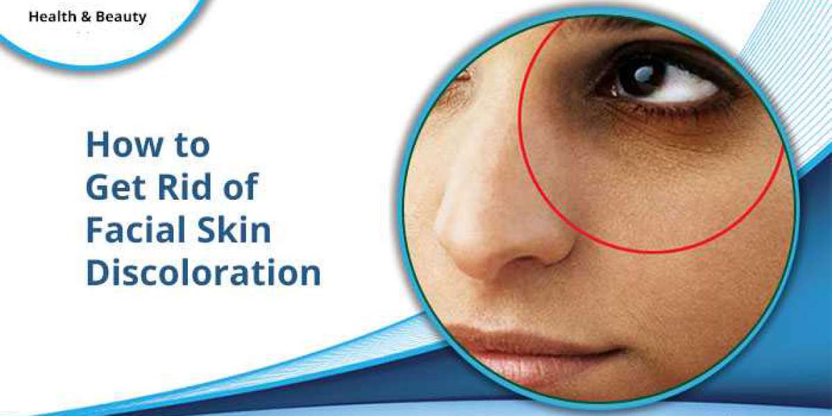 How to Get Rid of Facial Skin Discoloration