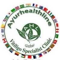 How to stop vitiligo from spreading? – Ayurhealthline Vitiligo Treatment