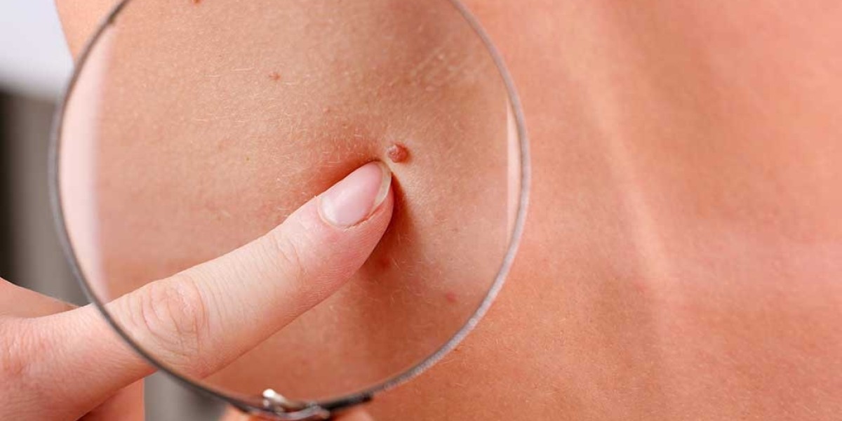 Skin Tag Remover- Tags And Moles Remover, Erfahrungen, Kaufen!