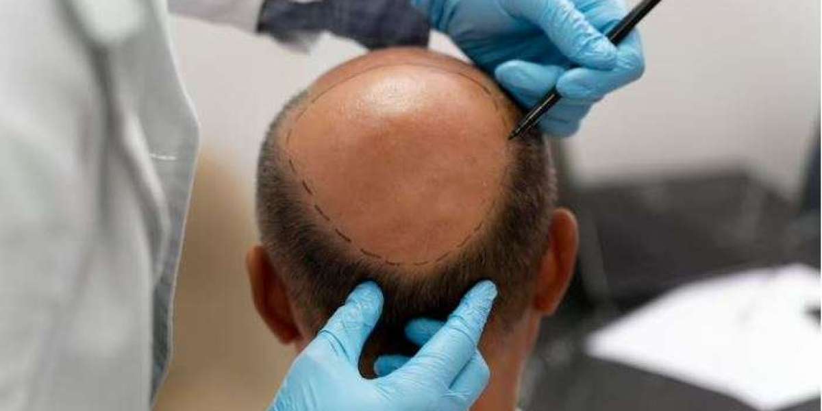 Top Dermatologist and Hair Transplant Surgeon in Indore - Dr. Abhishek Malviya