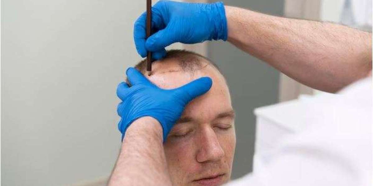 Reclaim Your Confidence with Expert Hair Transplant in Indore by Dr. Abhishek Malviya