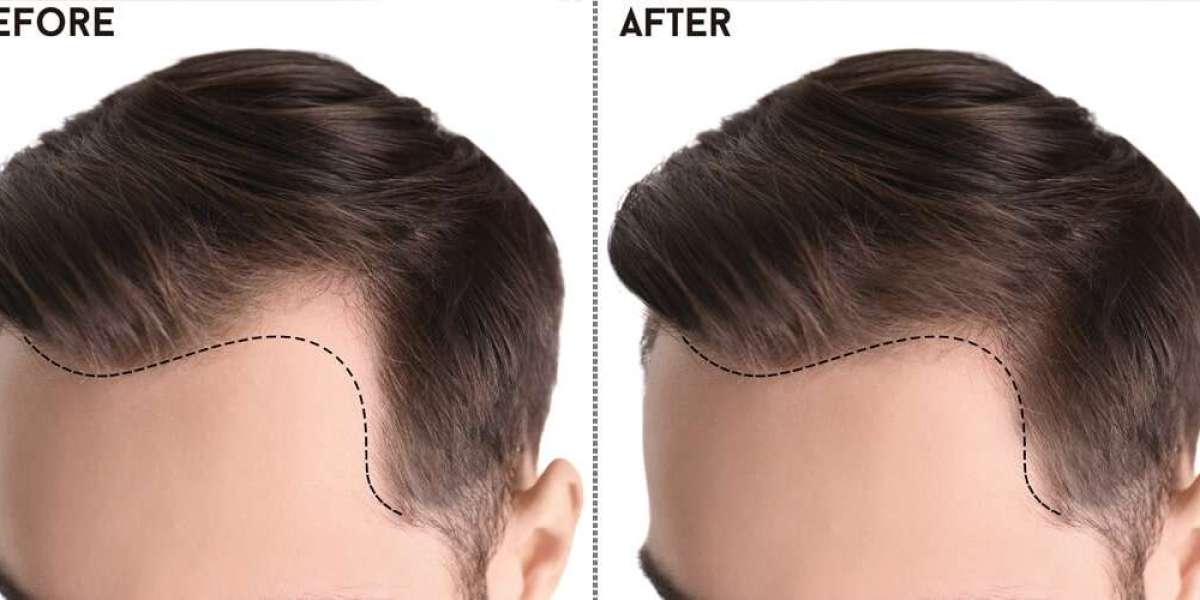 Unveiling the Beauty of Sapphire FUE Hair Transplant in Islamabad