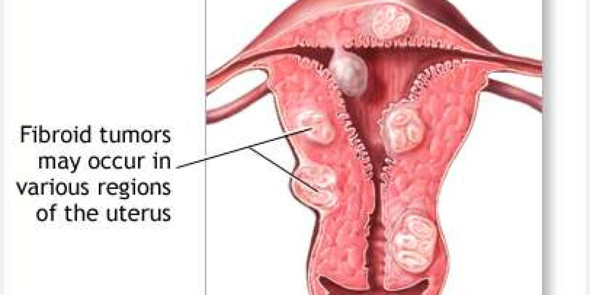 Uterine fibroids