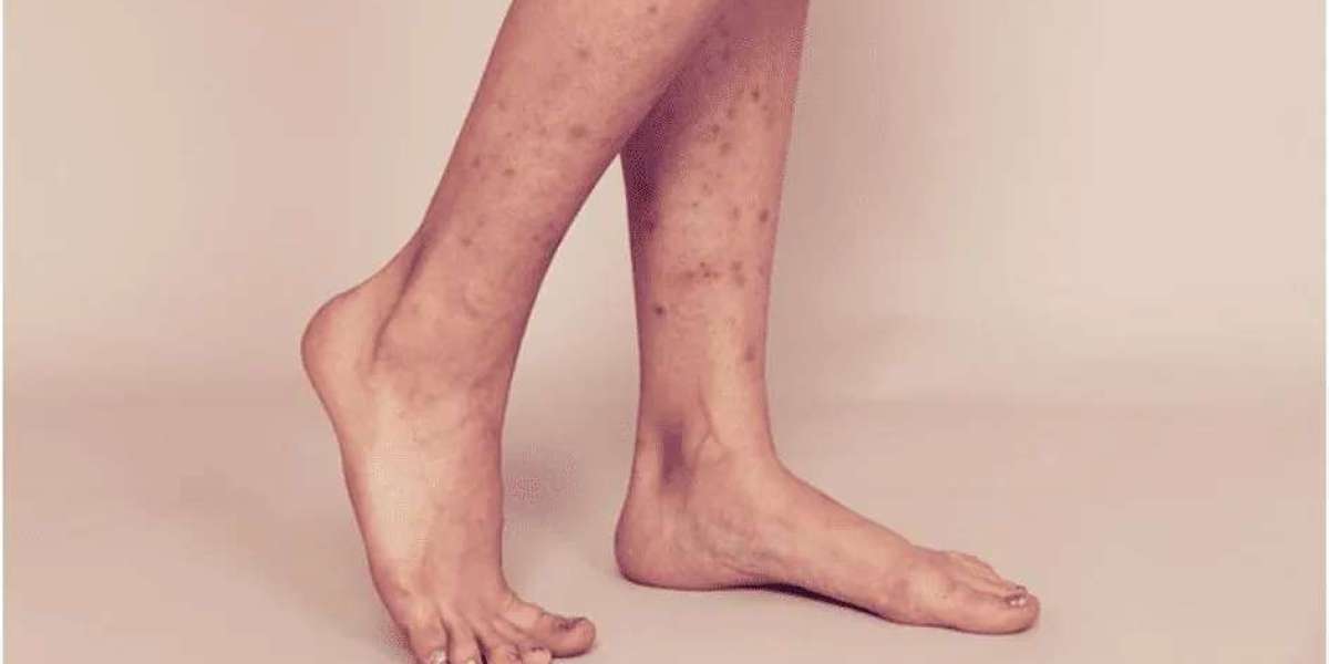 Understanding and Managing Black Freckles on Legs: Insights from Dr. Archit Aggarwal a leading Dermatologist  in Faridab