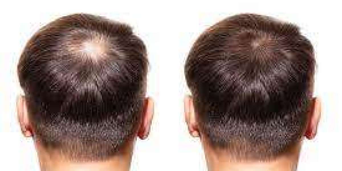 trasplante de cabello fut