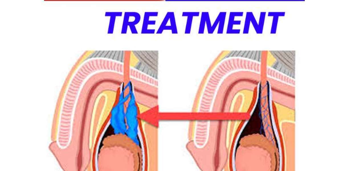 Varicocele non surgical treatment