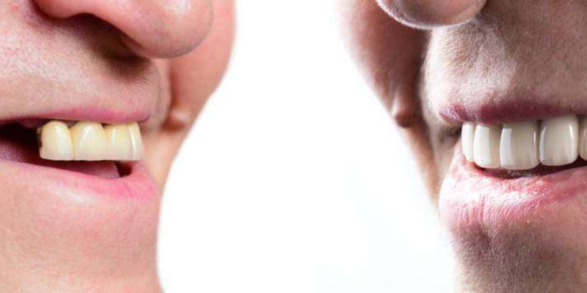 Transform Your Smile with Veneers: A Guide to Exceptional Dental Care in Preston