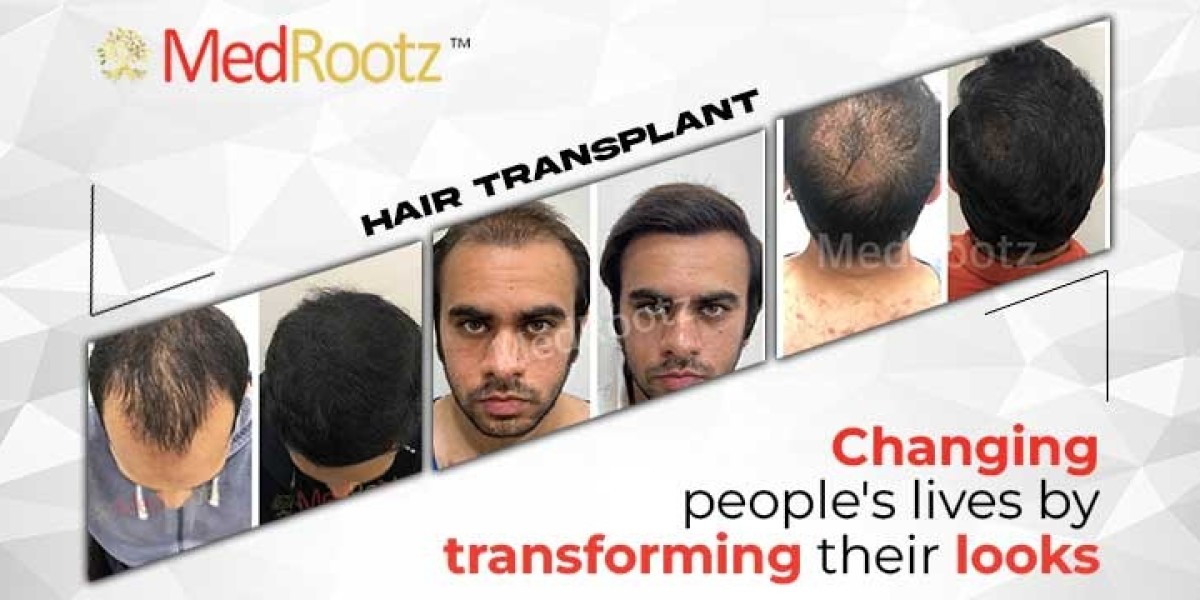 Best Hair Transplant In India | Med Rootz