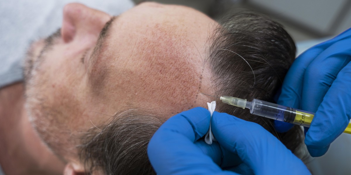 Hair Loss Treatment Perth