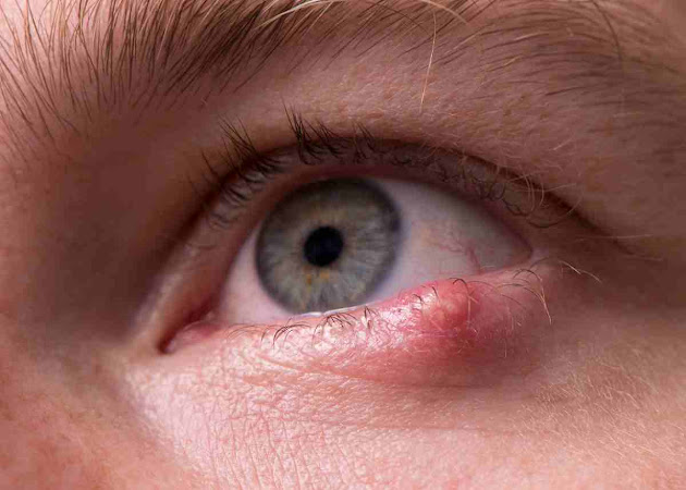 Advances in Hodgkin's Disease Treatment: A Beacon of Hope