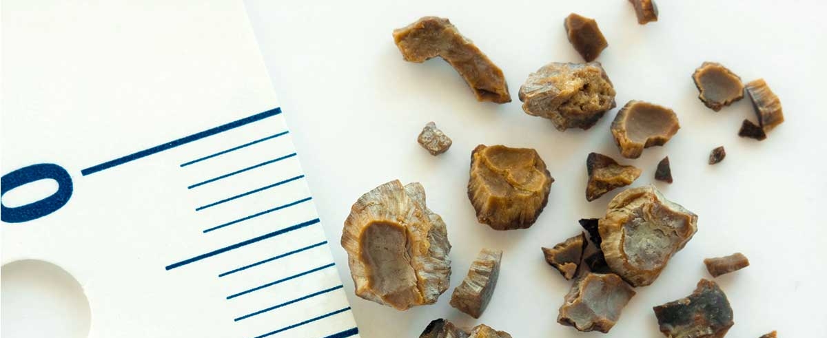Understanding the Dynamics of Kidney Stone Treatment in Bangalore – Ssurocare