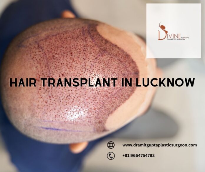 Best Results & Cost of Hair Transplant in Lucknow | Reviews Consumer Reports