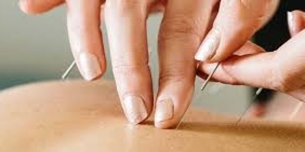 Exploring the Benefits of Chinese Acupuncture
