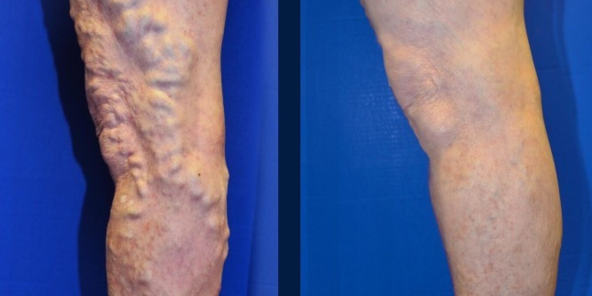 Rock Your Confidence: Conquer Reticular Veins with These Proven Remedies!