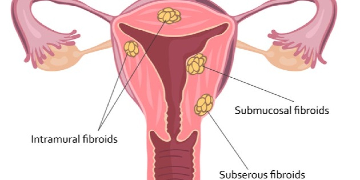 Healing Fibroids Naturally: Homeopathy Medicines in Zirakpur