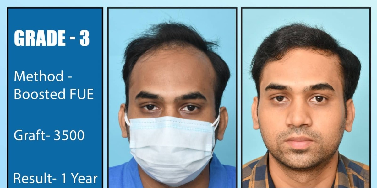 Exploring the Root Cause of Hair Loss in Men Understanding Causes and Myths