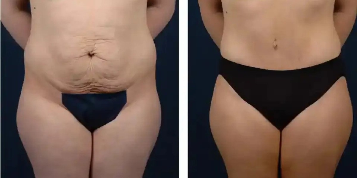 Tummy Tuck Techniques and Innovations in Dubai