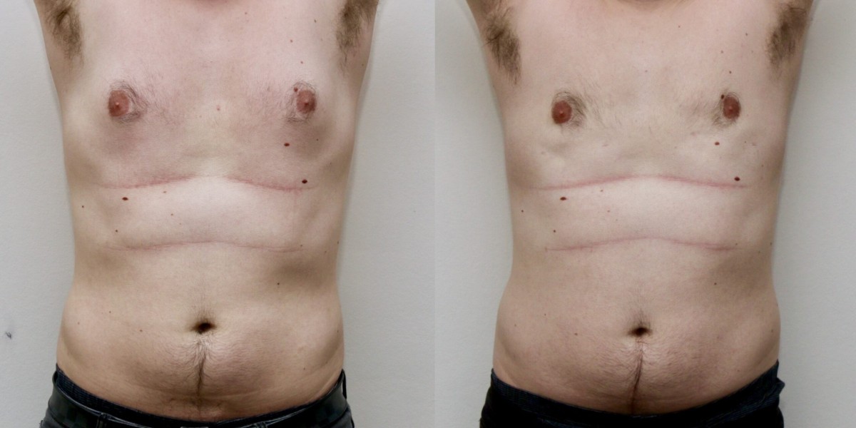 Celebrating Wellness: Gynecomastia Care in Dubai
