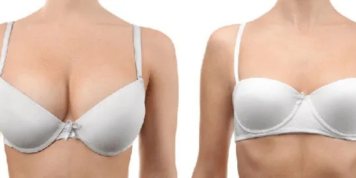 Long-Term Results of Breast Reduction Surgery: Enjoying a More Proportional Physique