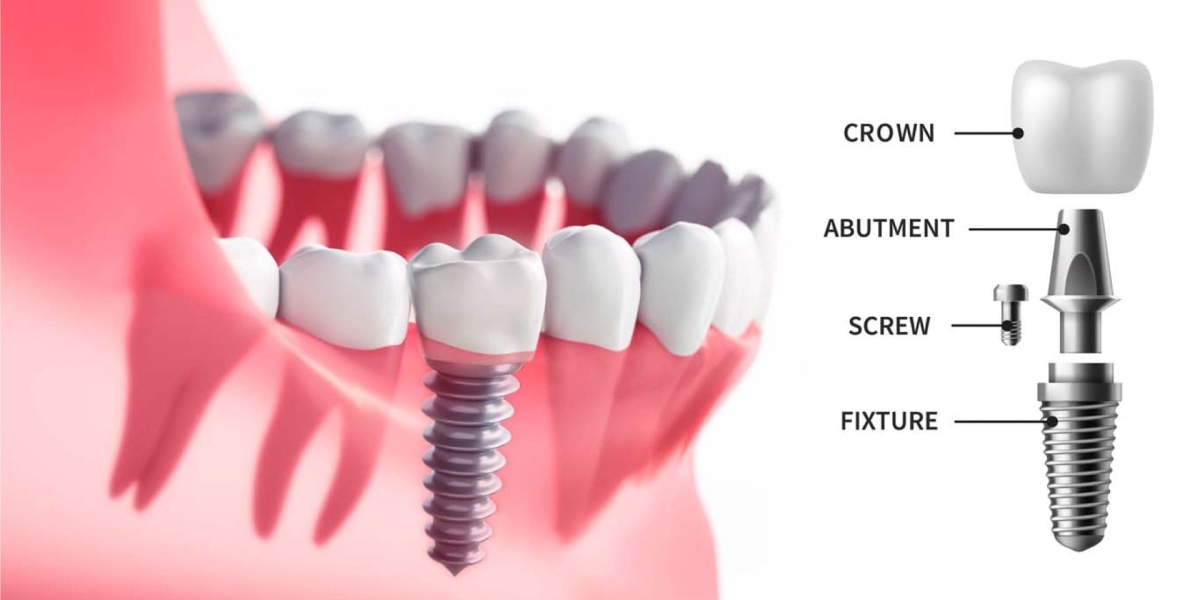 Comprehensive Dental Care in Western Sydney: Exploring Services from Villawood to Bankstown