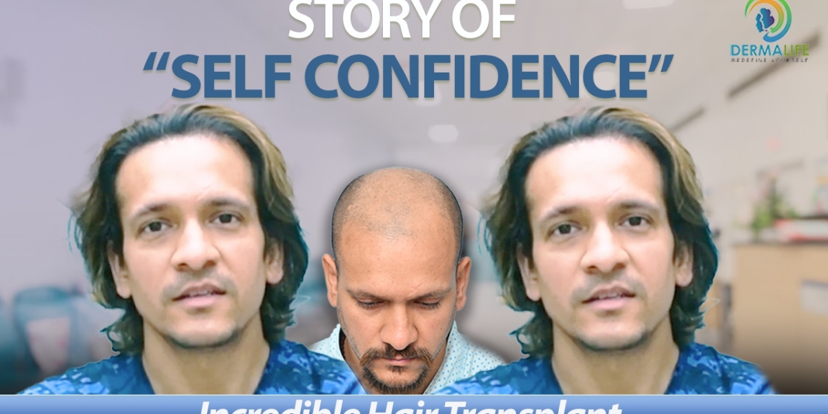Understanding Baldness Levels and Reasons to Choose Hair Transplant