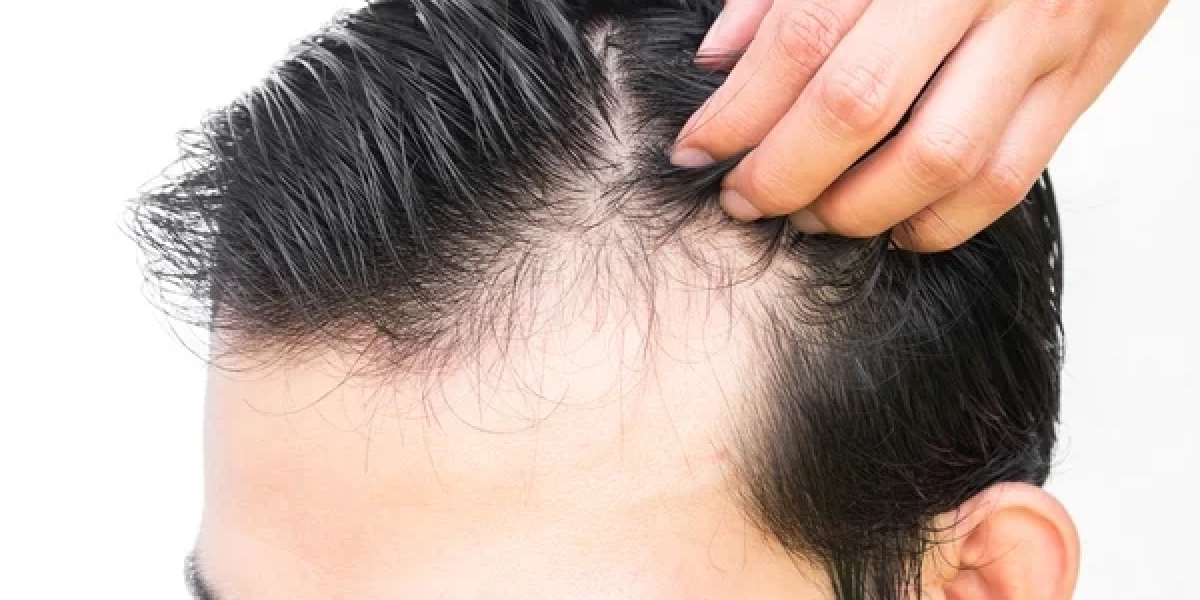 Can I wear a wig after my hair transplant?
