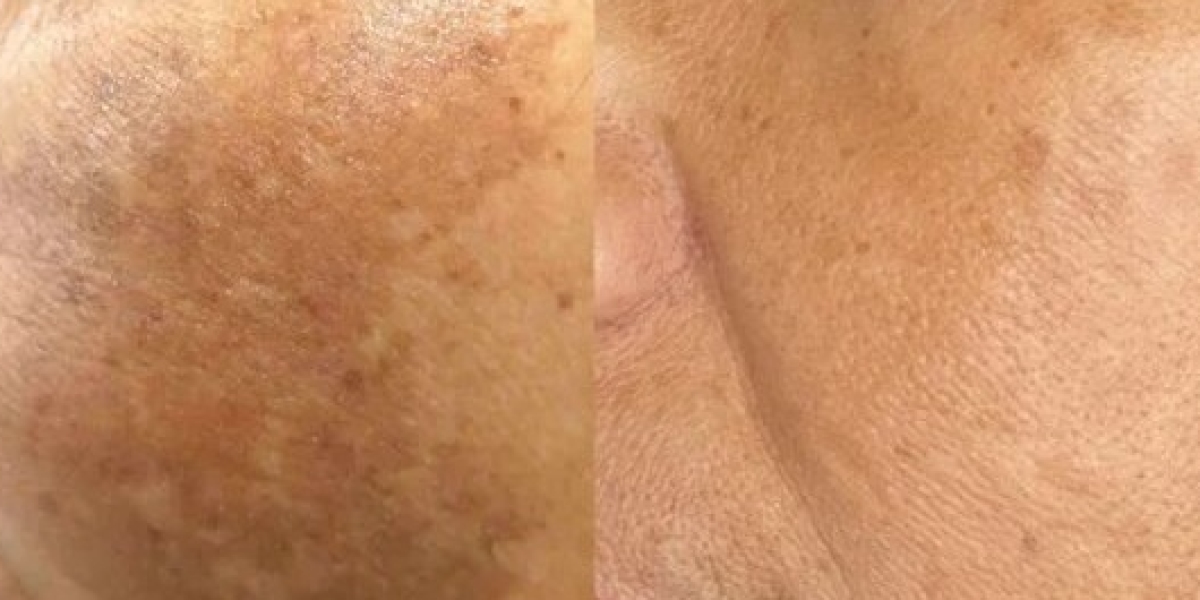 Best Melasma Treatments: Effective Ways to Remove Pigmentation