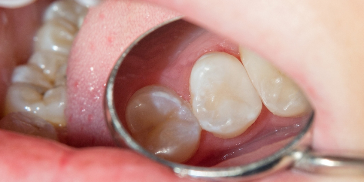 Title: The Ultimate Guide to Custom-Made Dentures in Boise: Tailoring Your Smile