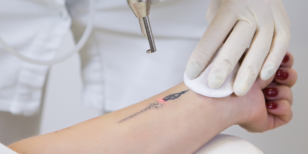 How Does Laser Tattoo Removal Handle Dark vs. Light Ink Colors?