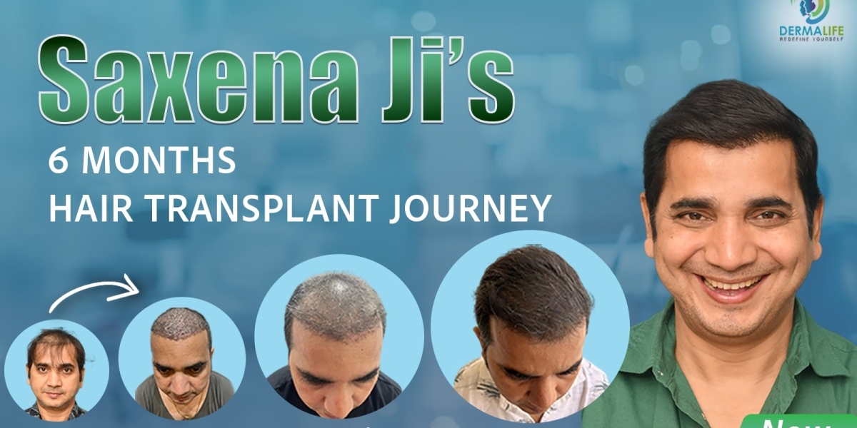 What You Need to Know to Pick the Best Hair Transplant Expert and Clinic