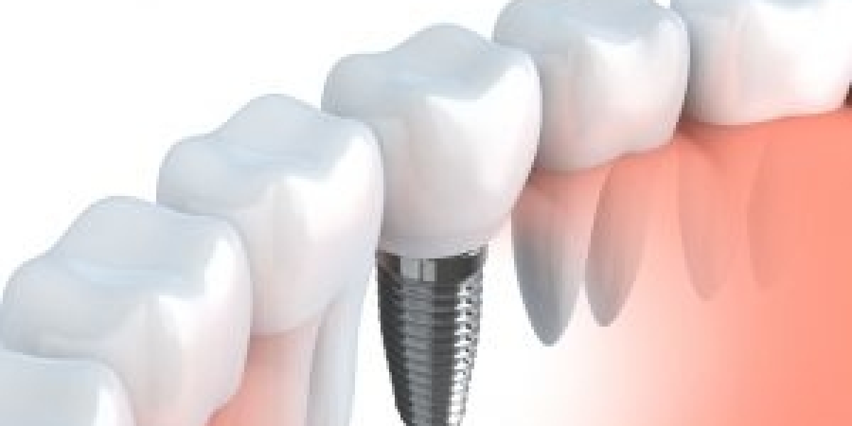 Achieve a Perfect Smile with Expert Dental Implants in Bexleyheath