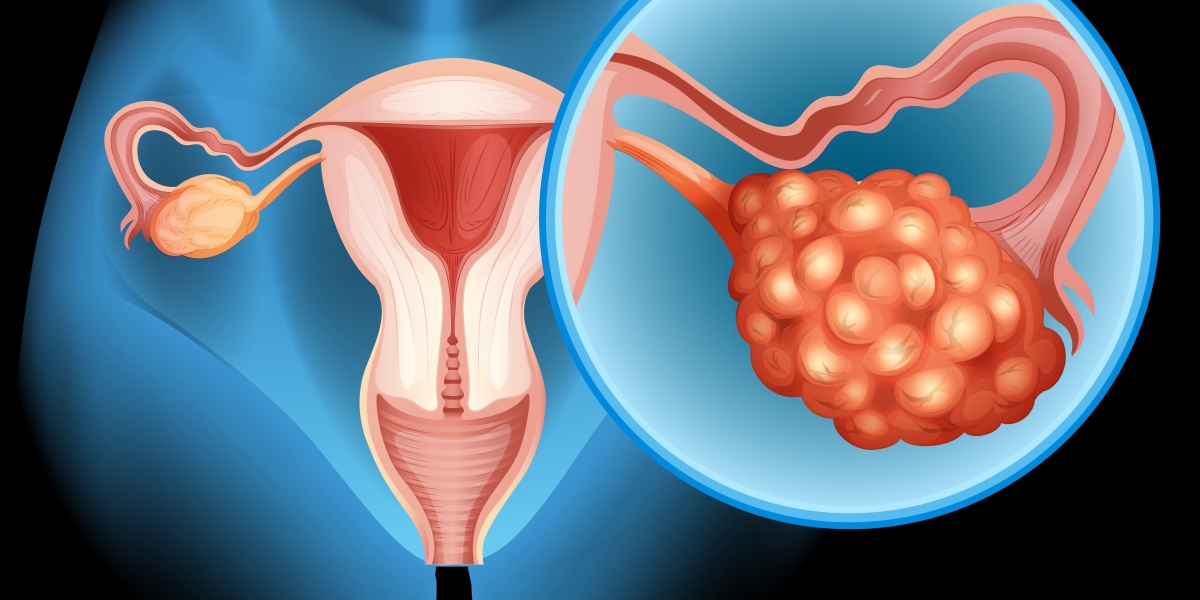 Can PCOS Be Cured? A Holistic Approach to Managing Polycystic Ovaries with Homeopathy