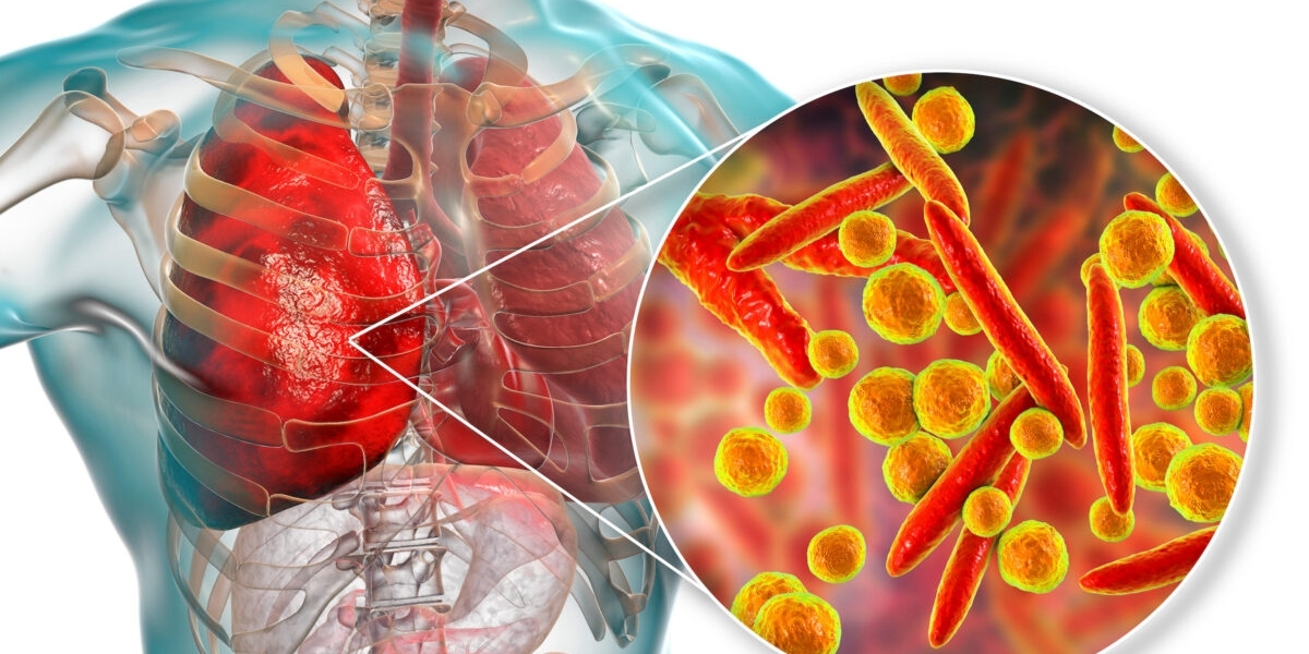 Pneumonia Therapeutics Market Detailed Overview, Scope, Trends and Forecast by 2031