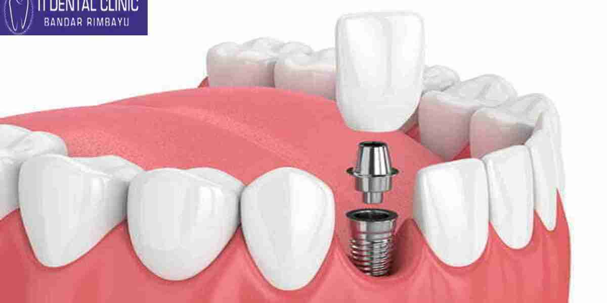 What Are Dental Implants?