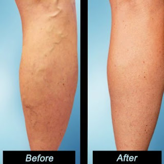 Signs You Need PAD Treatment from a Tampa Vascular Doctor