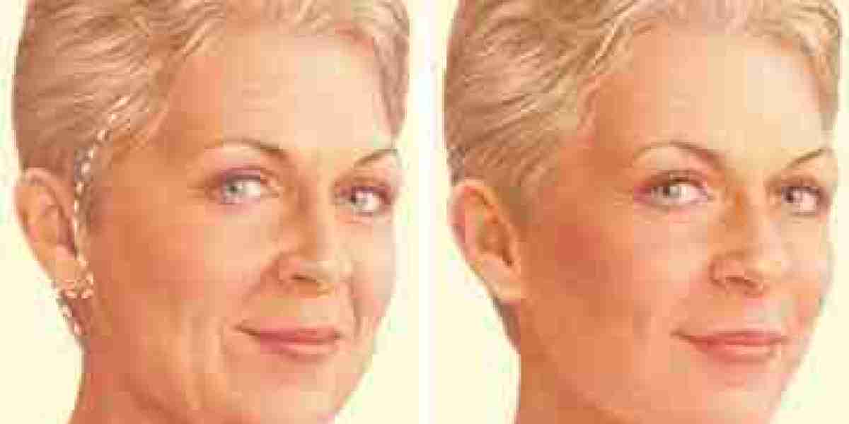 Deep Plane Facelift: When You Want to Look Refreshed, Not Recognizable